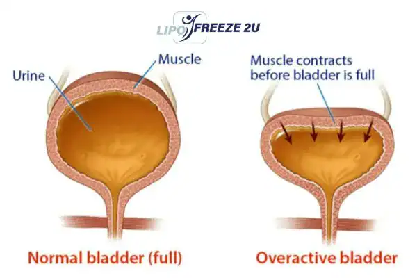 diagram of overactive bladder treatment Leicestershire