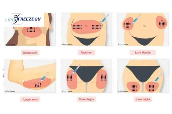 Benefits of Choosing Aqualyx for Fat Reduction Leicestershire