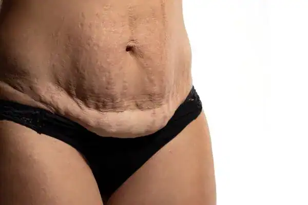 loose skin after weight loss injections Leicestershire