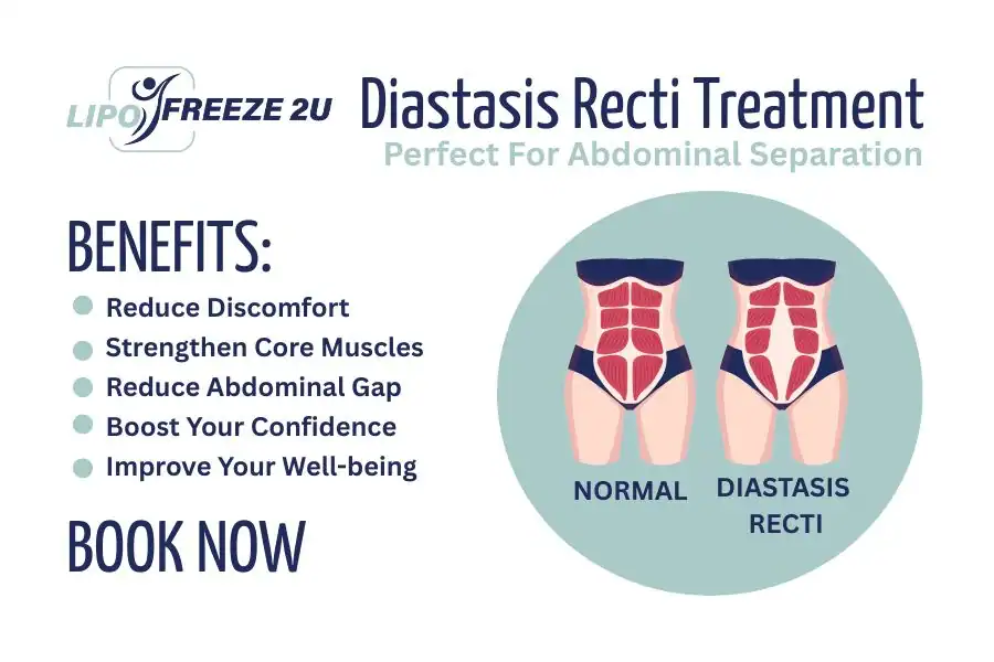 How Long Will It Take to See Improvements in Diastasis Recti Leicestershire