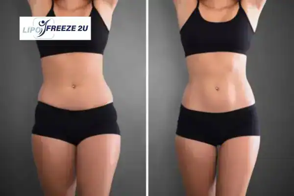 How Can LIPO FREEZE 2U Support Your Post-Pregnancy Body Recovery Leicestershire?