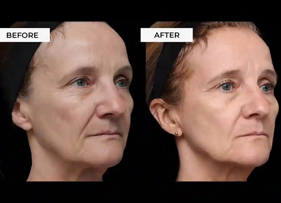 How Many RF Microneedling Sessions Will You Need to See a Difference Leicestershire?