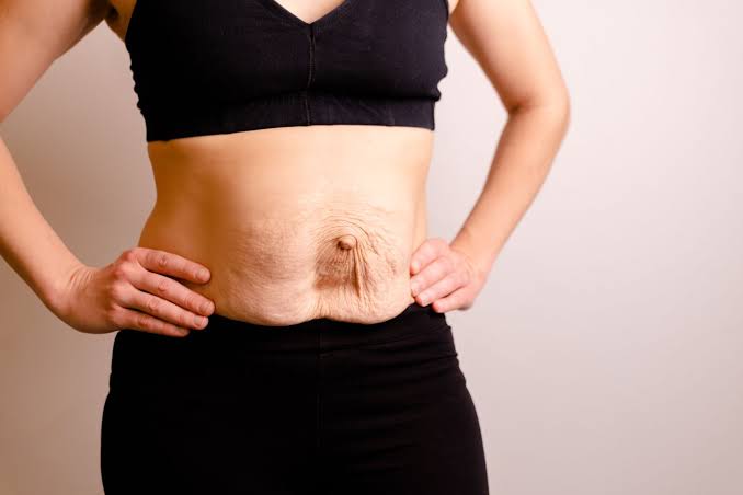 Is Surgery Really the Only Way to Repair Diastasis Recti Leicestershire?