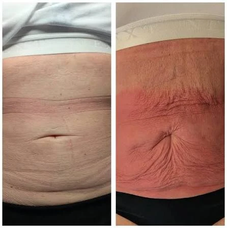 How Does RF Microneedling Improve Crepey, Thin and Uneven Skin Texture Leicestershire?