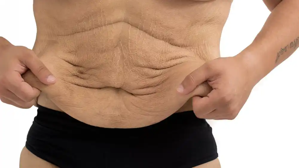 Why Does Weight Loss Medication Leave Some People With Loose or Sagging Skin Leicestershire?